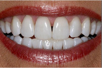 After Kor teeth whitening