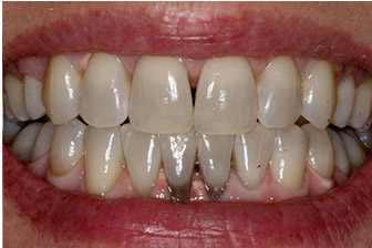 Before KöR Whitening