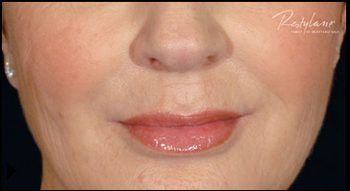 After Restylane