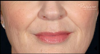 Before Restylane