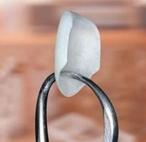 HIlton Head Porcelain Veneers