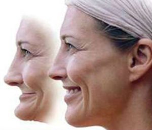 An illustration is facial collapse