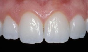 An example of textured teeth