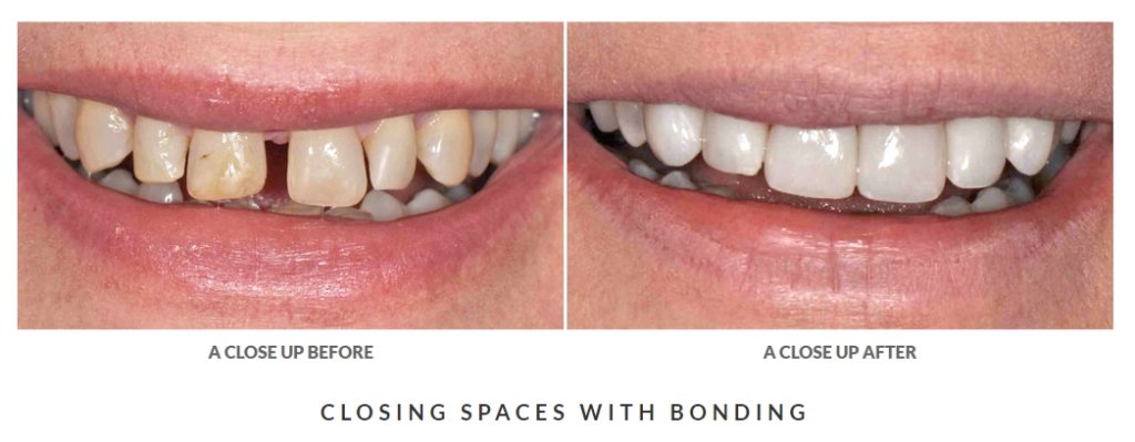 before and after dental bonding